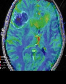 Intraoperative Darstellung der Durchblutung eines Hirntumors und des angrenzenden Gewebes (Perfusion)