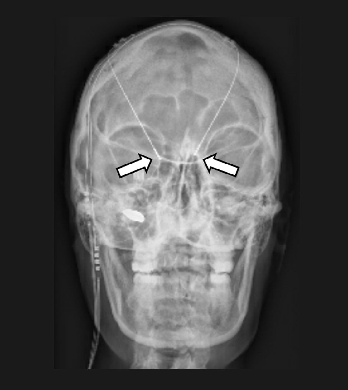 In das Gehirn implantierte Elektroden zur Tiefen Hirnstimulation (Pfeile)