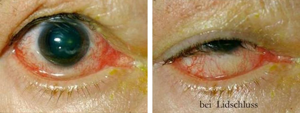 Lähmung des Gesichtsnerven mit Tieferstand des Unterlides sowie stark vermindertem Lidschluss
