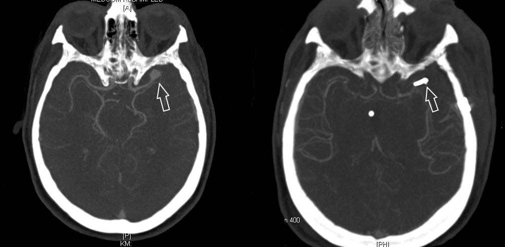 CT Angiographie eines Aneurysmas