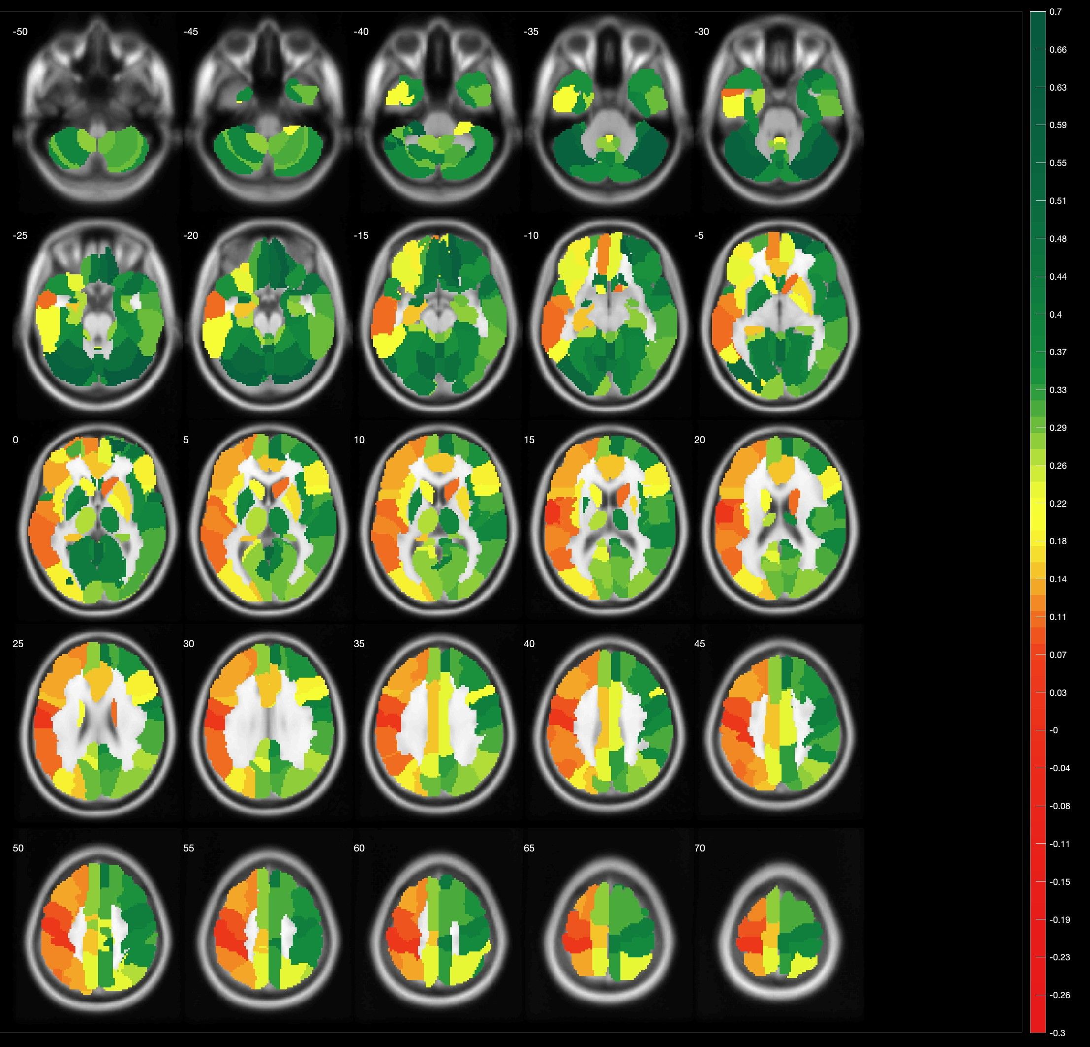 Darstellung im breathhold fMRT
