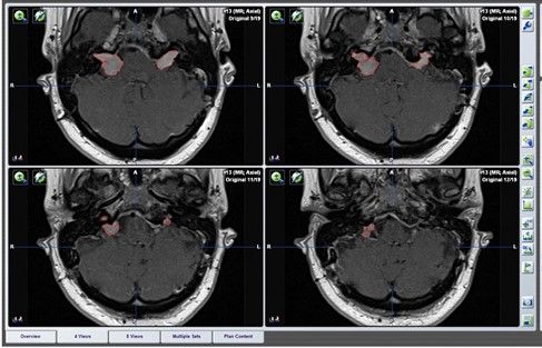Tumorvolumetrie der beidseitigen Vestibularisschwannome