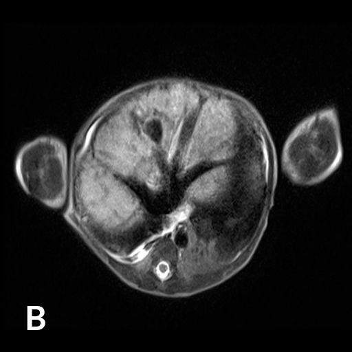 Wissenschaftliche Abbildung Leberhämangiom