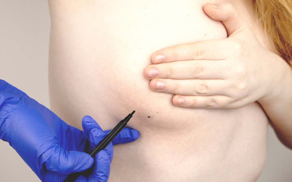 Brust wird angezeichnet für OP