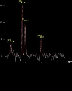 Intraoperative Darstellung der chemischen Zusammensetzung von Tumorgewebe im MRT (Spektroskopie)