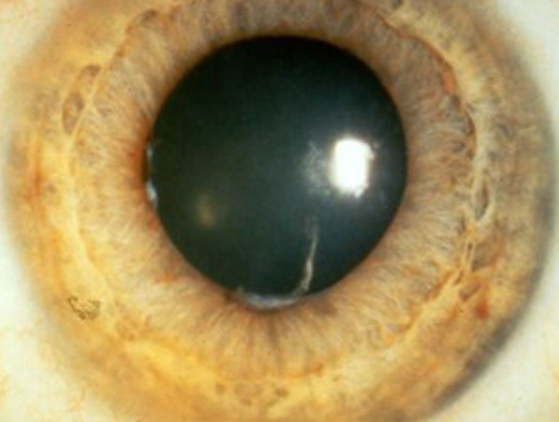 Nahmaufnahme eines Auges mit Uveitis