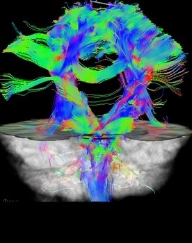 Intraoperative Darstellung der Faserbahnen des Gehirns (DTI)