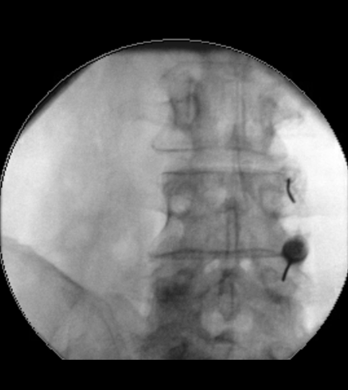 Infiltration von Facettengelenken