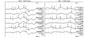 AEP–Akustisch Evozierte Potentiale