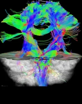 Intraoperative Darstellung der Faserbahnen des Gehirns (DTI)