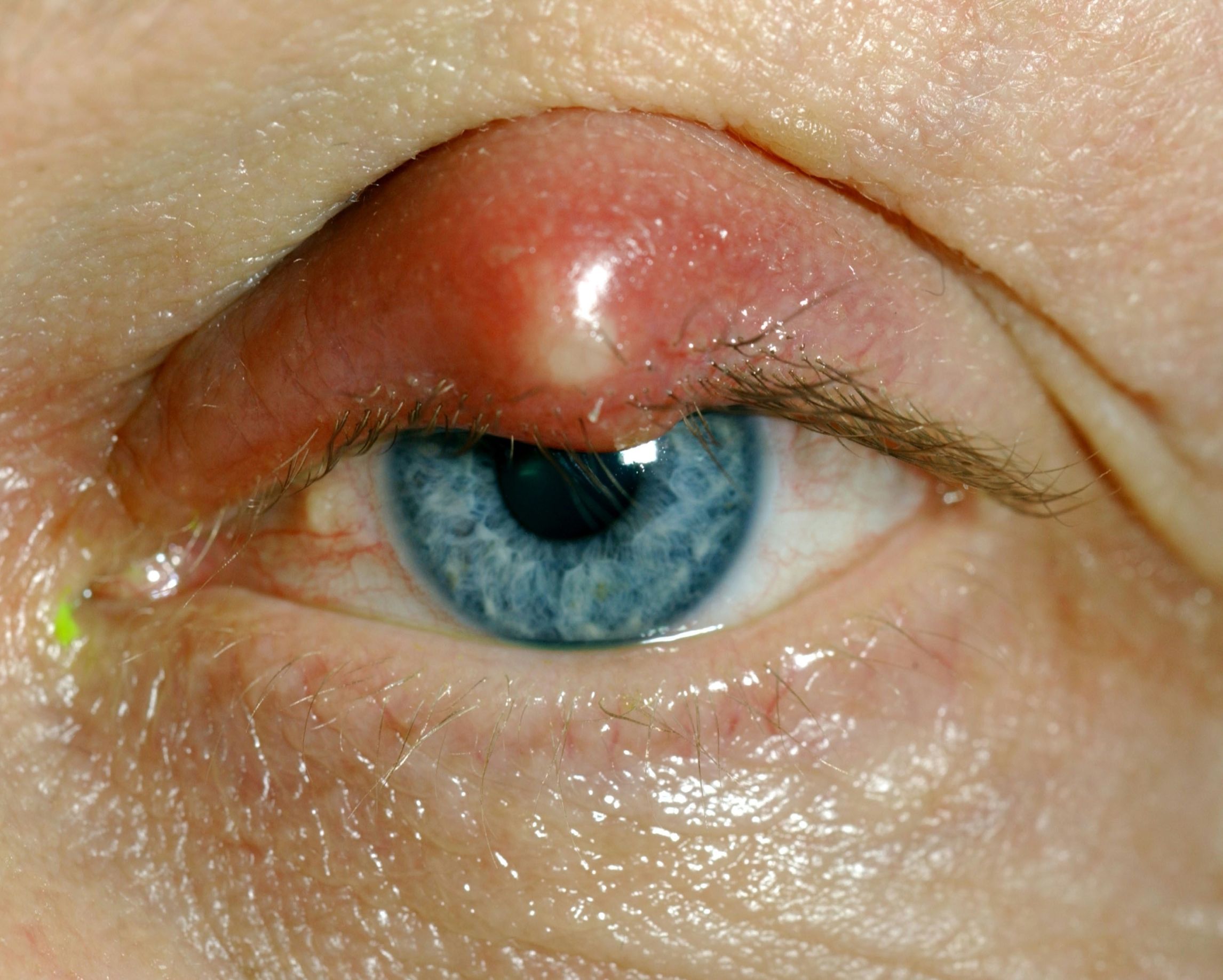 Abbildung eines entzündeten Auges