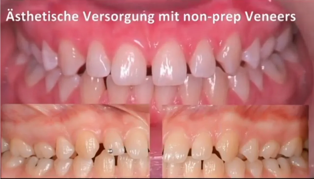 Startfolie Video: Zähne mit Titel Ästhetische Versorgung mit Non prep veneers