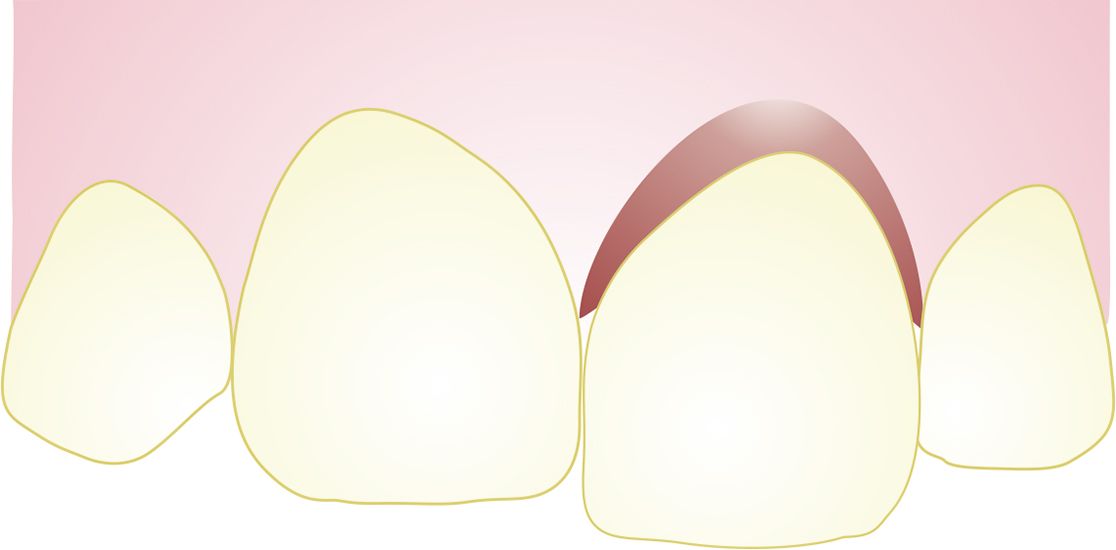 Drawing of a displaced tooth