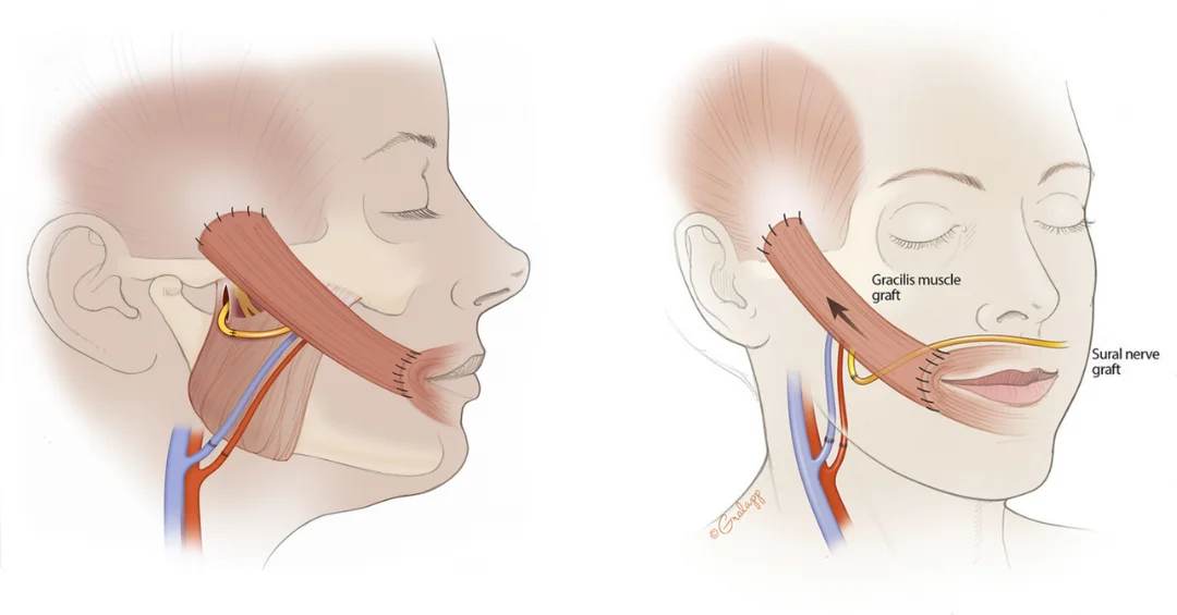 Abbildung 5: Freies Muskeltransplantat des M. Gracilis mit neuer Gefäßversorgung (A. und V. facialis) und Nervenkoaptation zum N. Massetericus (rechts) oder einem Crossface-Nerve-Graft (links)