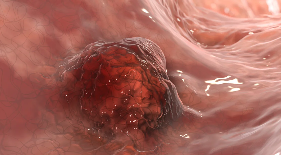 Tumor im Darm