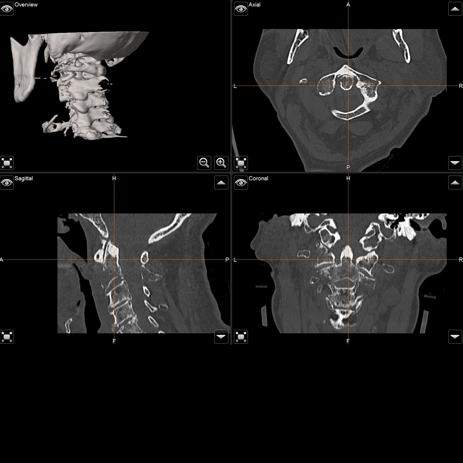 Intraoperative 2D und 3D Darstellung eines Patienten vor und nach kraniozervikaler Fusion mittels eines Schrauben-Stab-Systems.