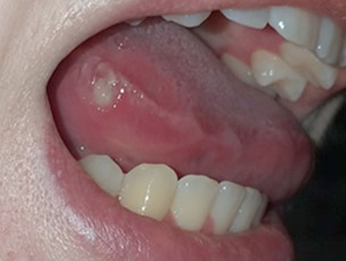 Aufnahme einer Aphthe an der Zunge