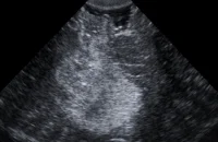 Ultraschallbild vor Resektion