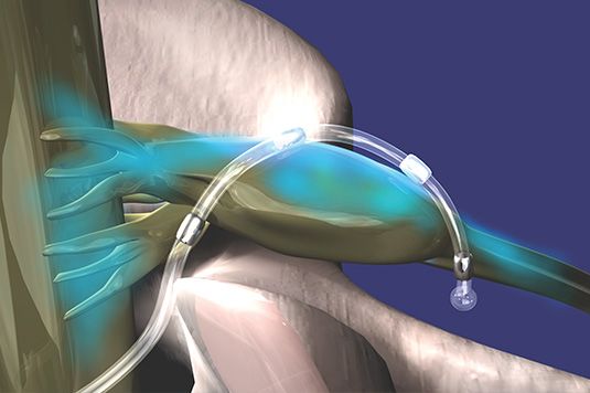 Grafische Darstellung einer Dorsalganglienstimulation