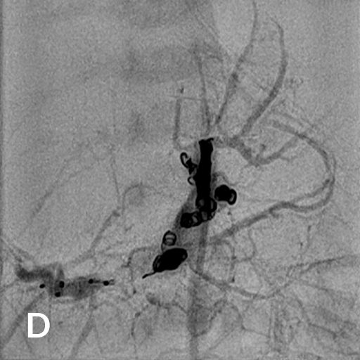 Wissenschaftliche Abbildung Leberhämangiom