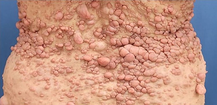 Neurofibrome am Rücken