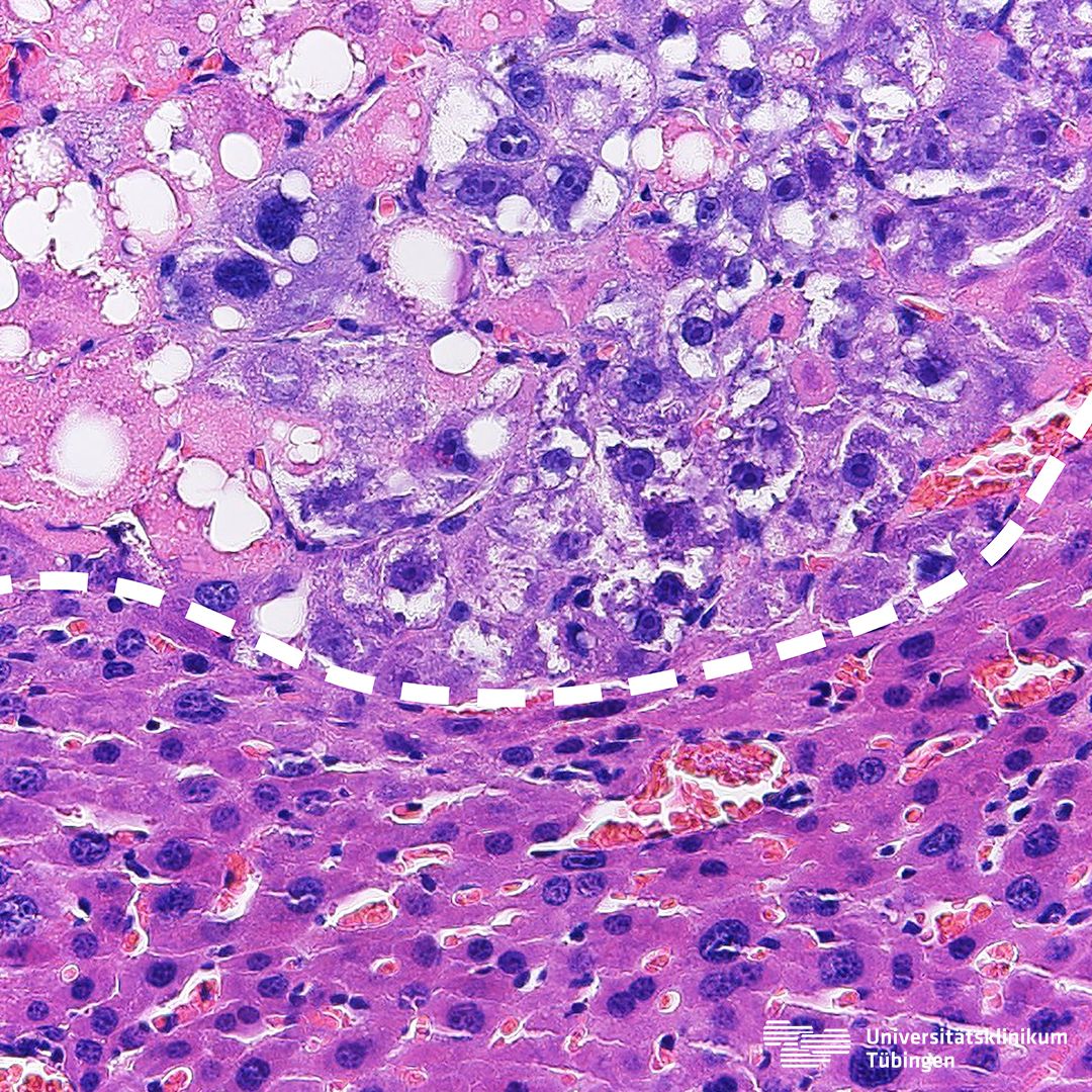 Leberzelltumor unter Mikroskop
