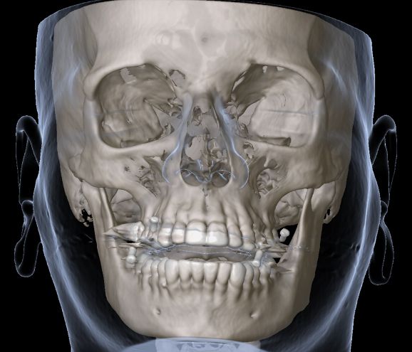 Computerdarstellung des Schädels
