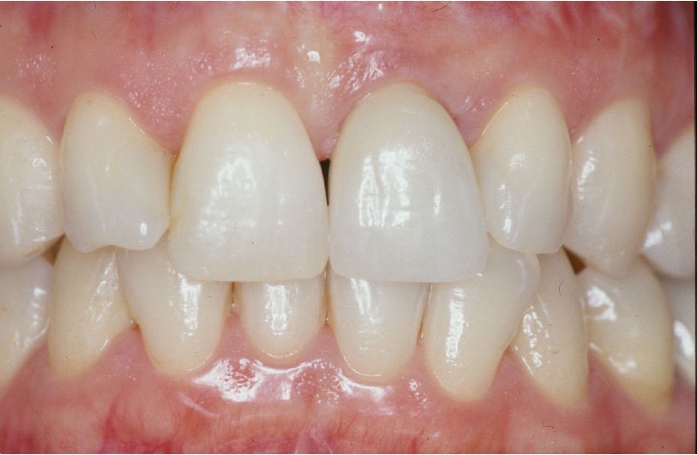 Abbildung eines Mundes mit implantiertem Schneidezahn