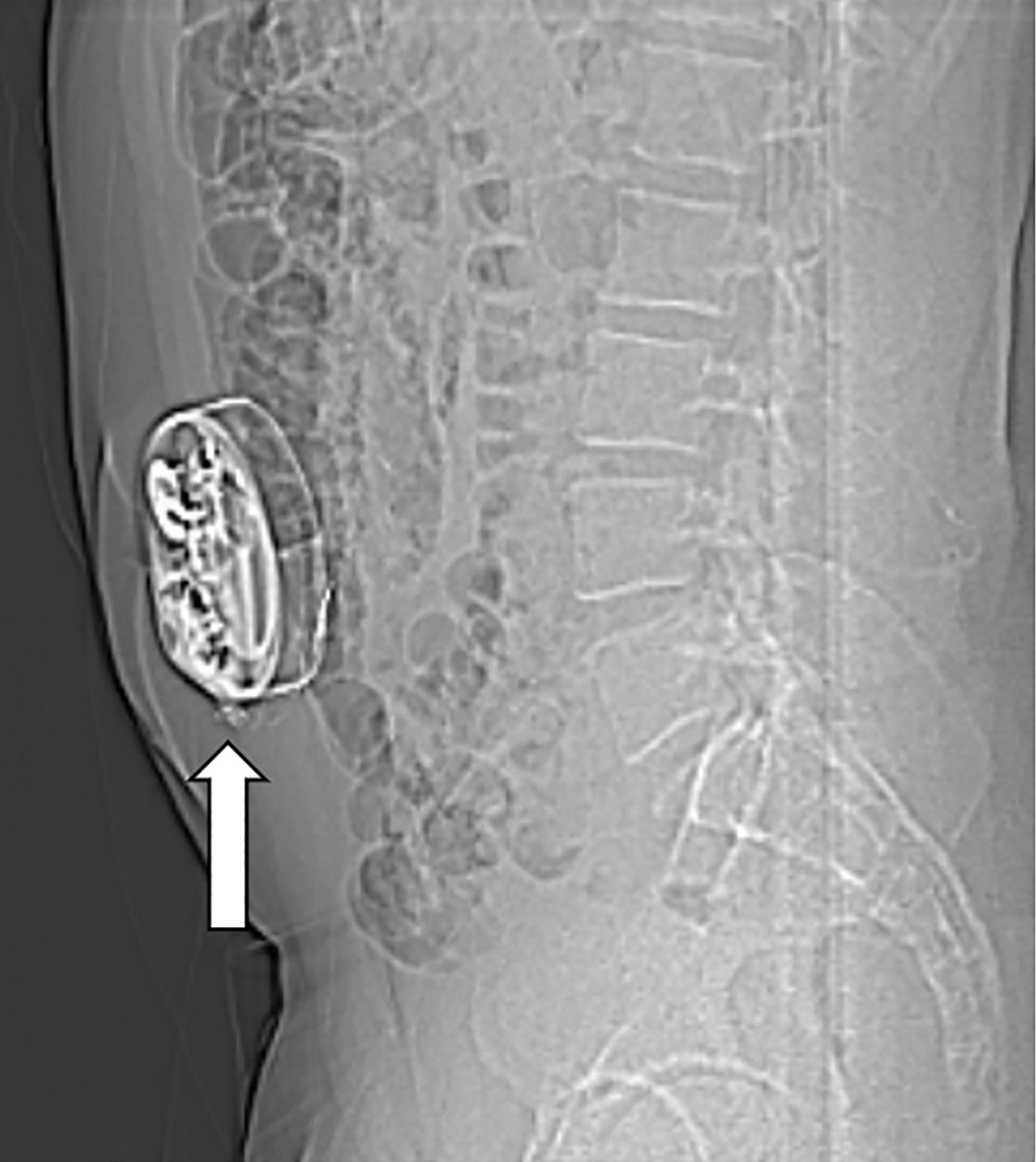 Am Bauch implantierte Medikamentenpumpe (Pfeil)