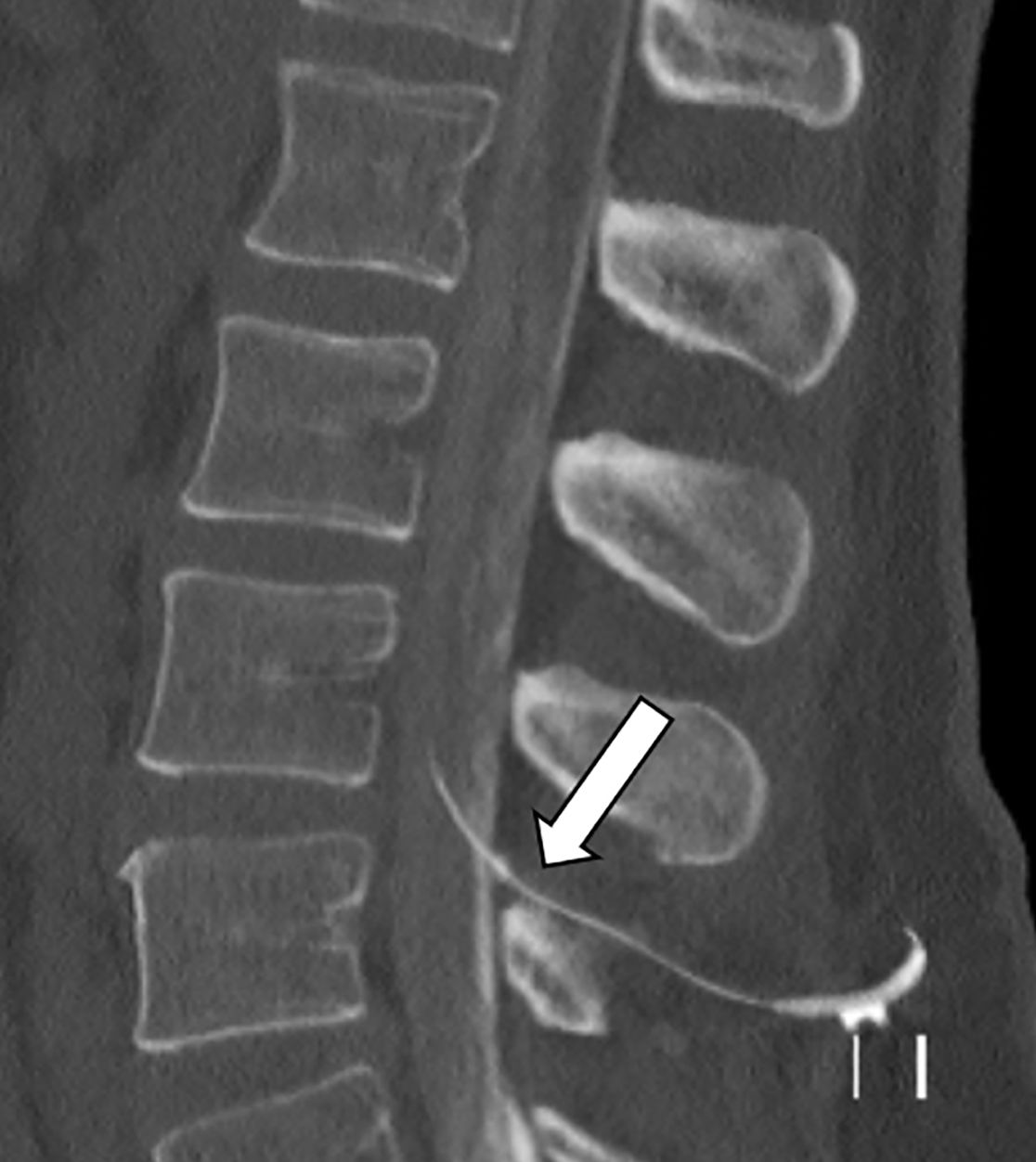 Im Nervenwasserraum (Liquor) einliegender Schlauch zur intrathekalen Therapie (Pfeil)