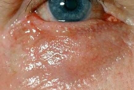 Nach plastischer Wiederherstellung