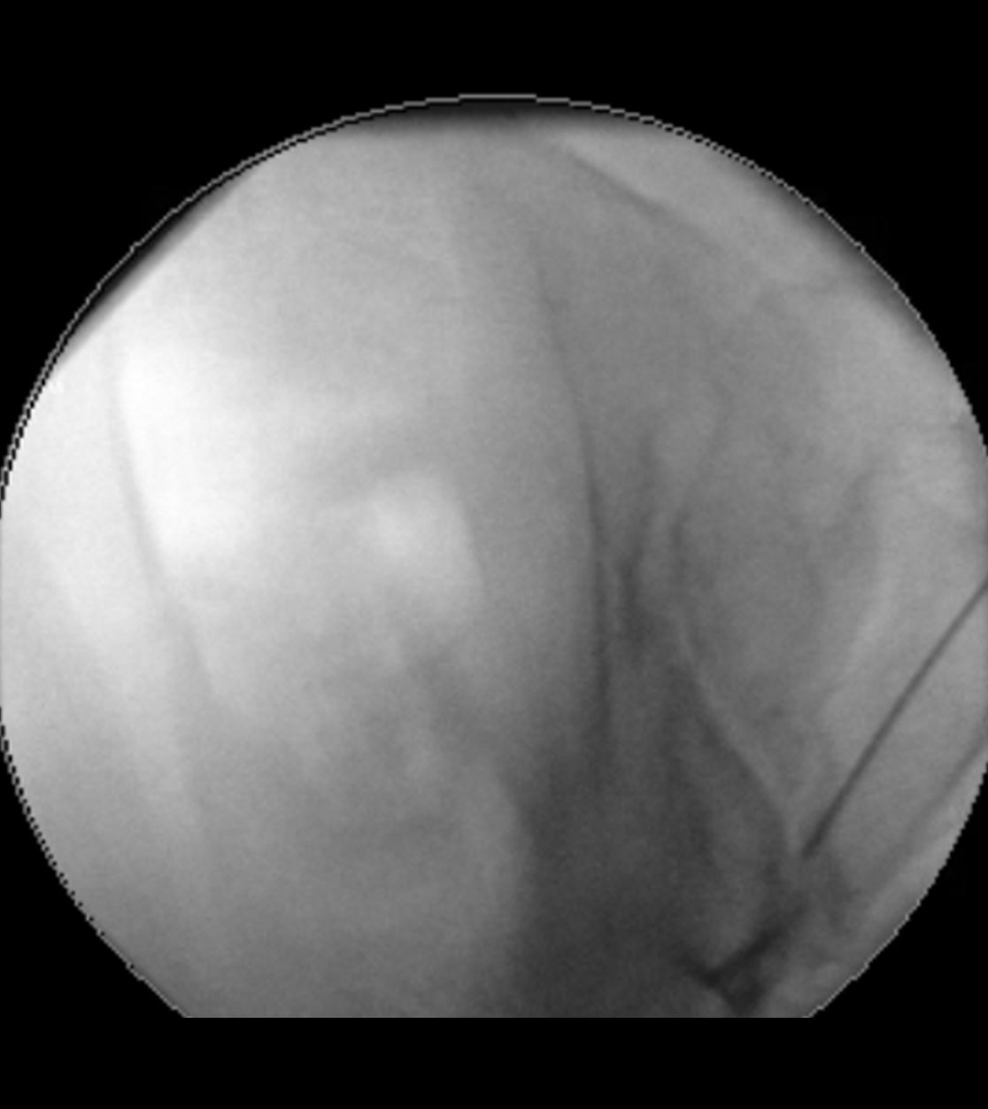 Infiltration eines Ileosakralgelenks