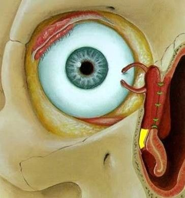 Bypass vom Tränensack in die Nase unter Umgehen des Tränengangs