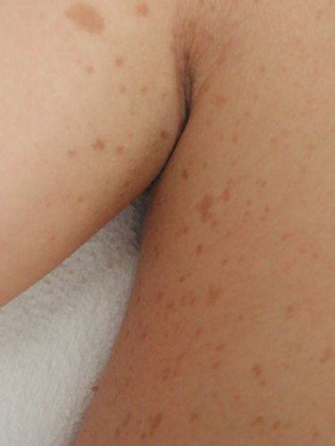 Sogenanntes „Freckling“ in der Achsel