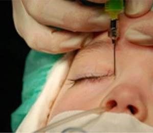 Tränenwegsondierung