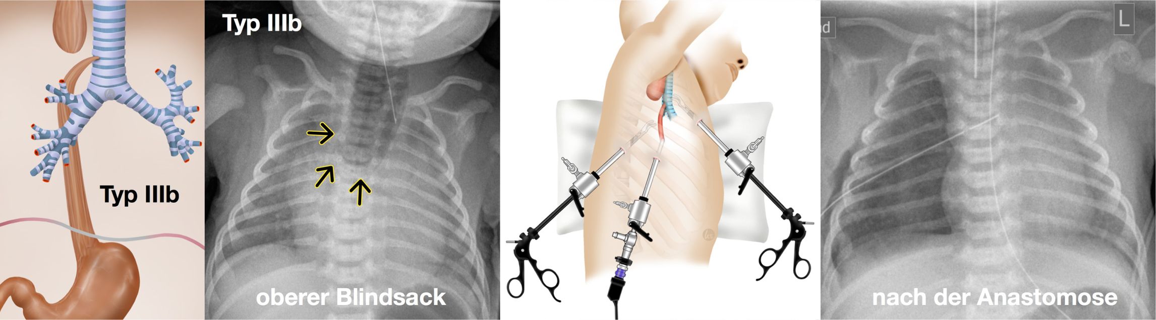 Ösophagusatresie: Abb. links Typ IIIb, Abb. rechts daneben Typ IIIb oderer Blindsack. Abb. ganz rechts nach der Ananstomose.