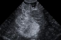 Ultraschallbild vor Resektion