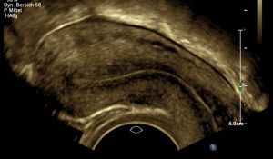 Gynäkologischer Ultraschall