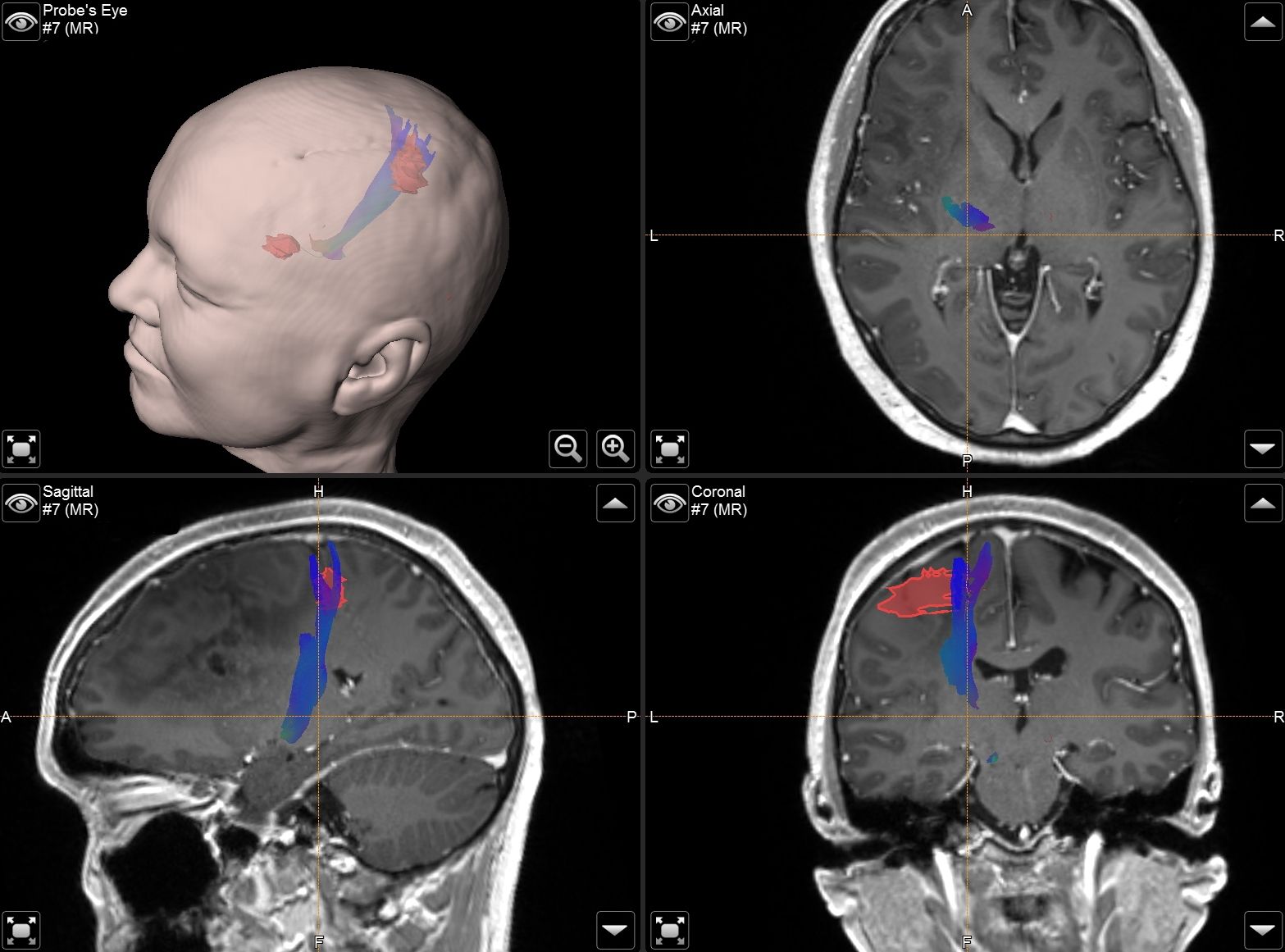 Screenshot der intraoperativen Navigation mit Darstellung von Faserbahnen und funktionellen Arealen des Gehirns.