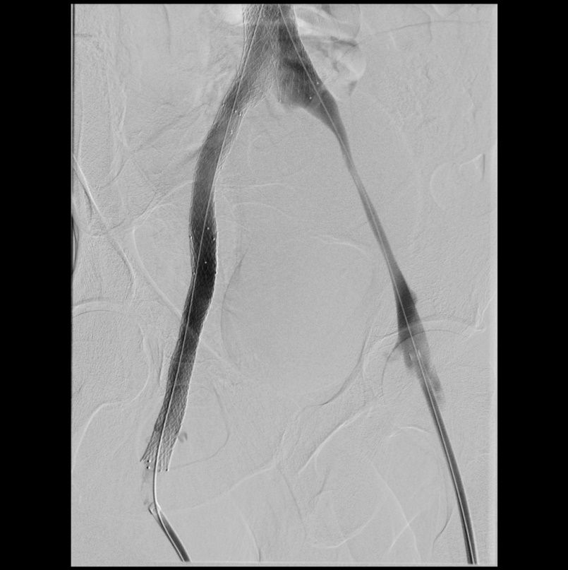 Venöse Intervention