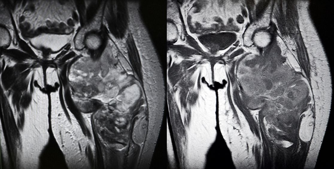 Sarkom der Oberschenkel, MRI