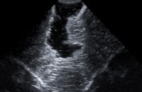 Ultraschallbild nach Resektion