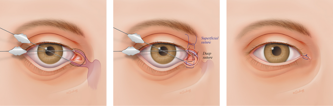 Abbildung 9: Mediale Canthoplastik (Schrit für Schritt)