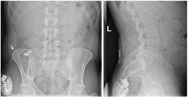 Röntgenbild zur Dorsalganglienstimulation