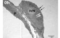 intravaskulärer PMN