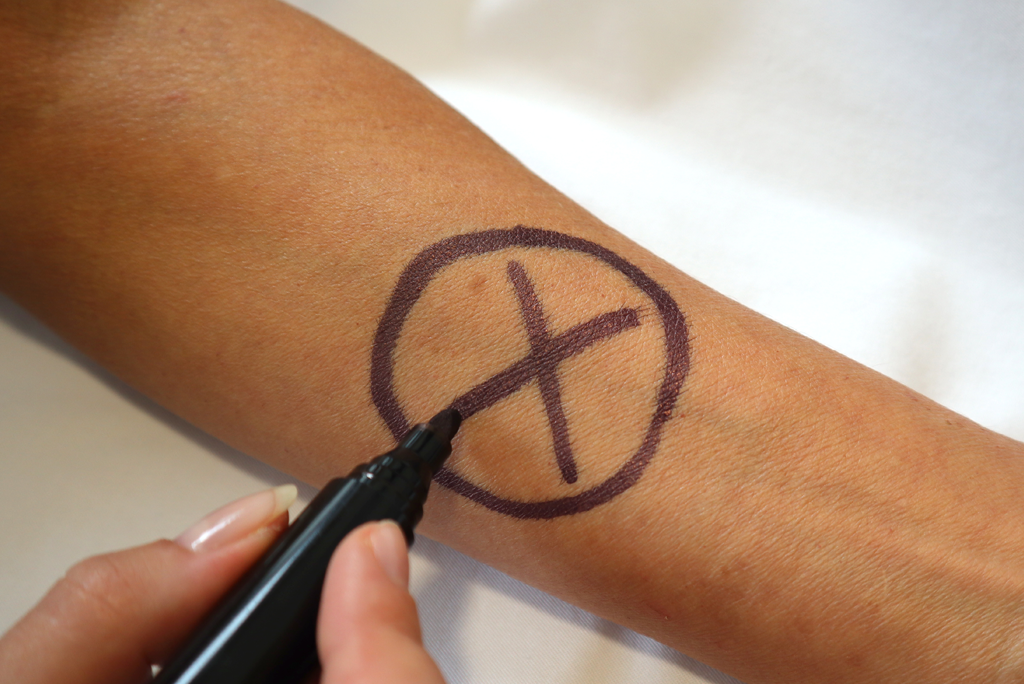 Vor einer Operation wird die zu operierende Stelle mit einem Marker markiert.