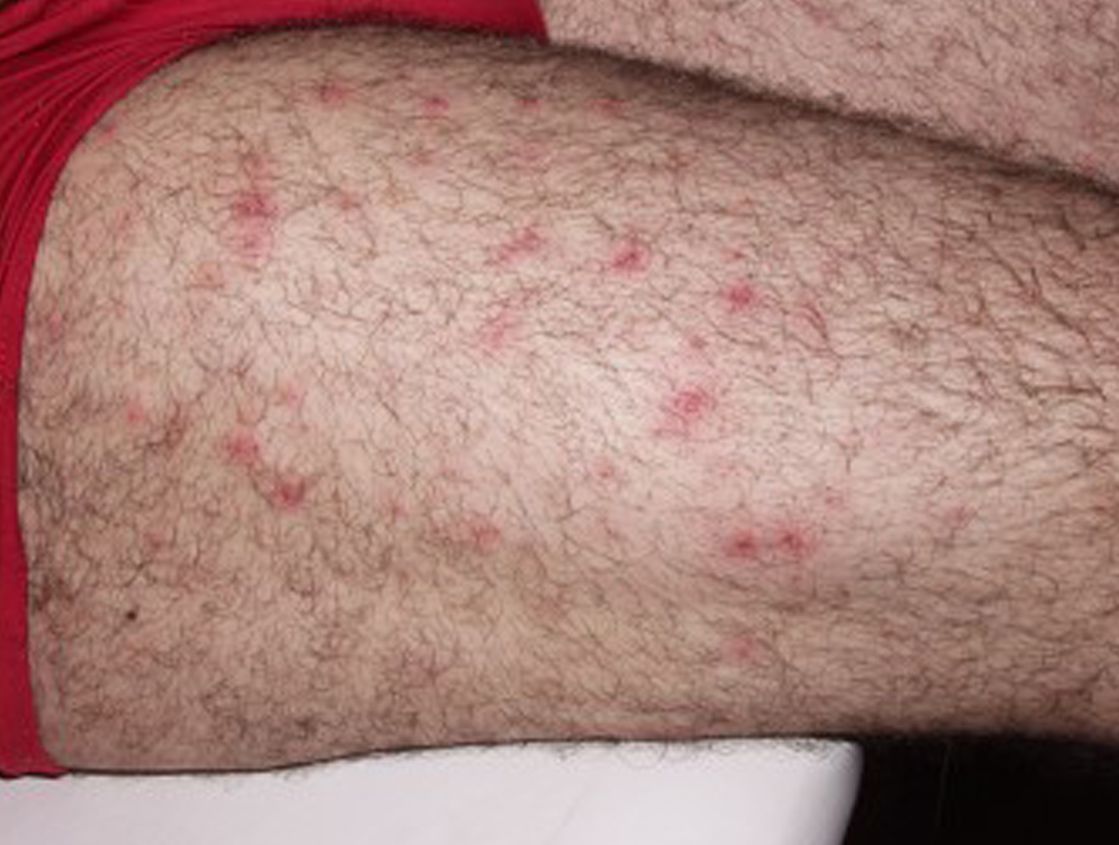 Aufnahme eines Oberschenkels mit roten Pusteln