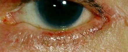 Normale Unterlidstellung nach operativer Korrektur