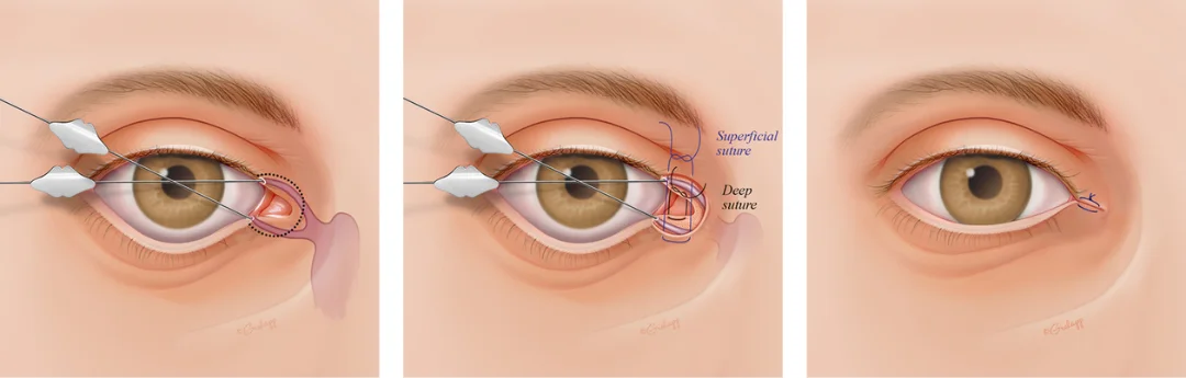 Abbildung 9: Mediale Canthoplastik (Schrit für Schritt)
