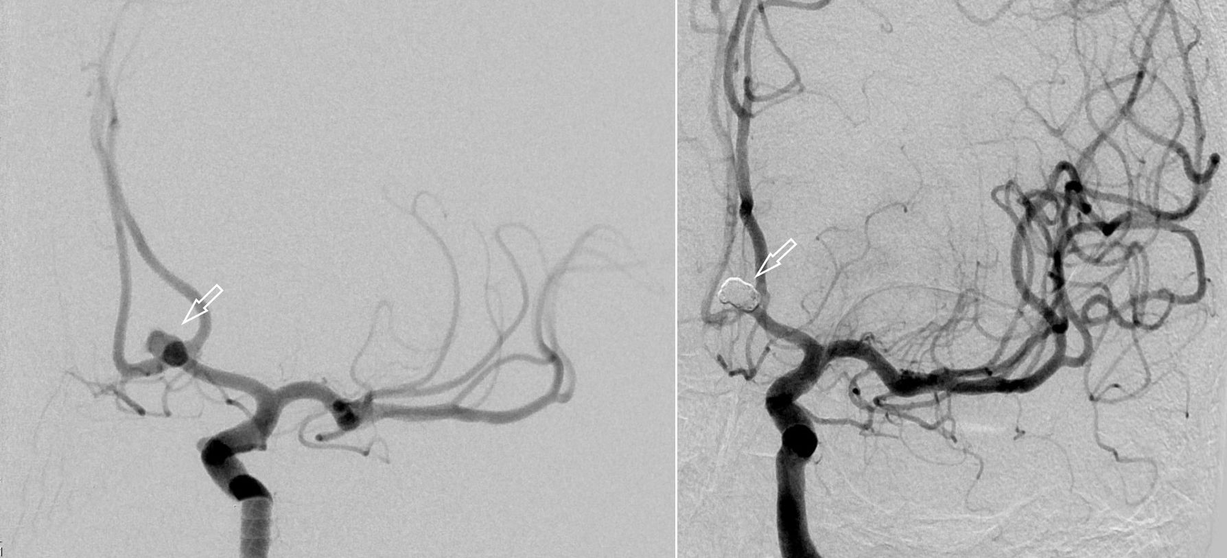 Angiographiesche Darstellung eines Aneurysmas